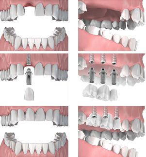 Implantes
